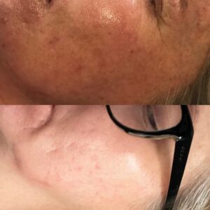 Microneedling 03