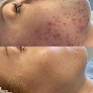 Microneedling 01