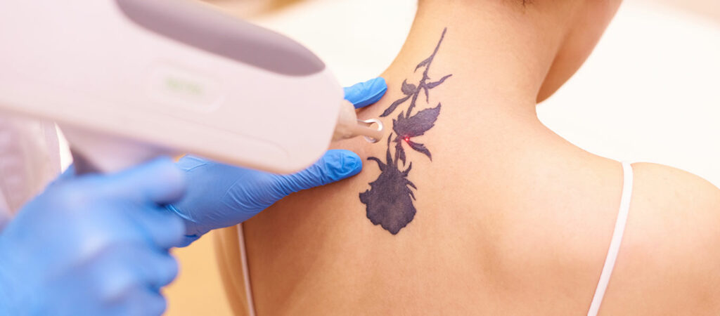 Qswitched ND YAG Laser Tattoo Removal - Skintec