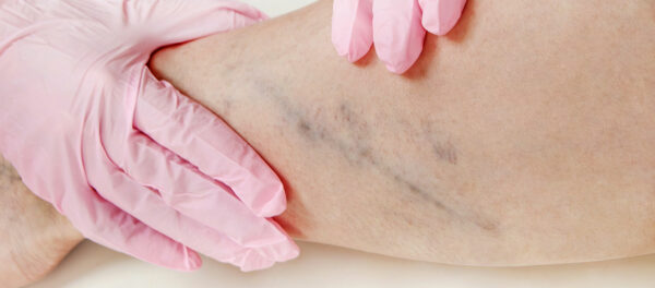 Skintec Sclerotherapy