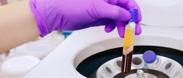 PRP (Platelet Rich Plasma)