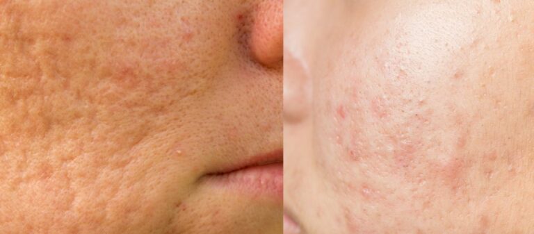 Acne Scarring