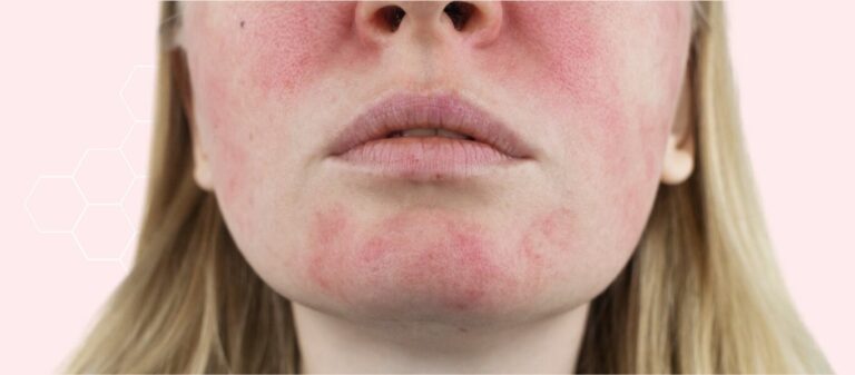 Rosacea