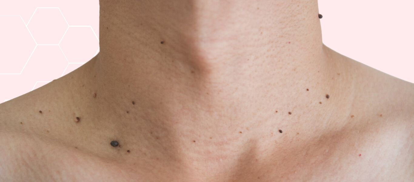 Warts, Milia, and Skin Tags